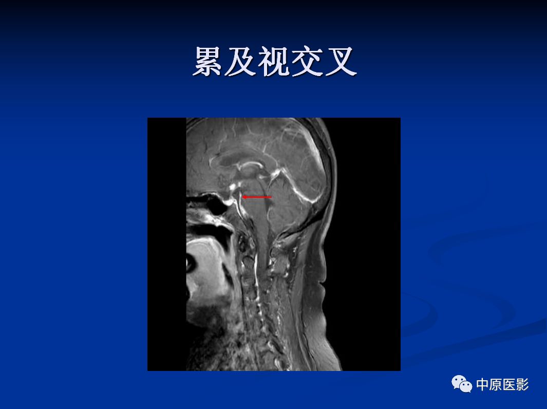 影像PPT - 【PPT】视神经脊髓炎谱系病的MRI诊断-27
