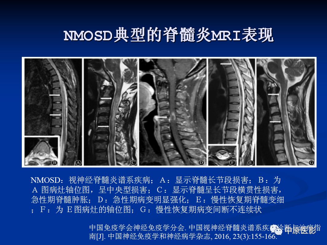 影像PPT - 【PPT】视神经脊髓炎谱系病的MRI诊断-32