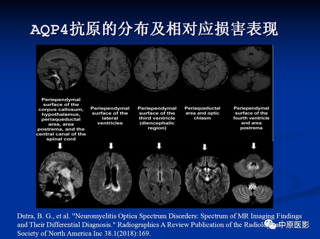 影像PPT - 【PPT】视神经脊髓炎谱系病的MRI诊断-18