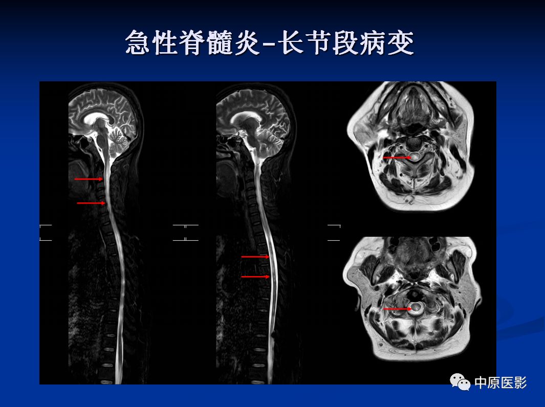 影像PPT - 【PPT】视神经脊髓炎谱系病的MRI诊断-34