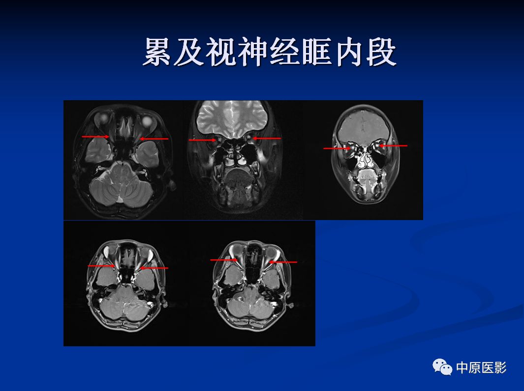 影像PPT - 【PPT】视神经脊髓炎谱系病的MRI诊断-26