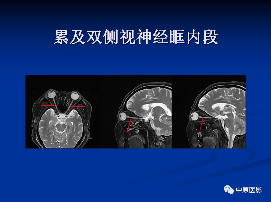 影像PPT - 【PPT】视神经脊髓炎谱系病的MRI诊断-25