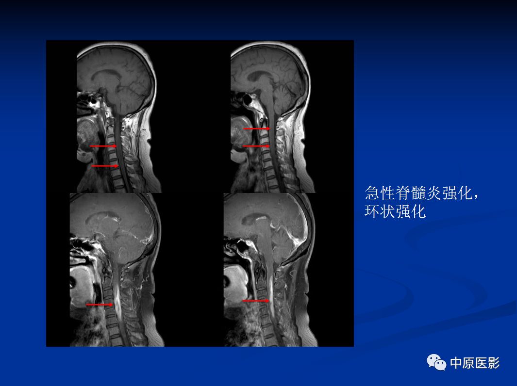 影像PPT - 【PPT】视神经脊髓炎谱系病的MRI诊断-35