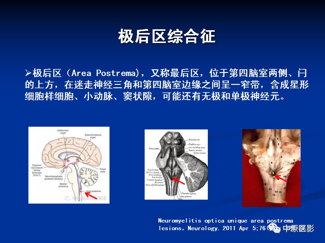 影像PPT - 【PPT】视神经脊髓炎谱系病的MRI诊断-38