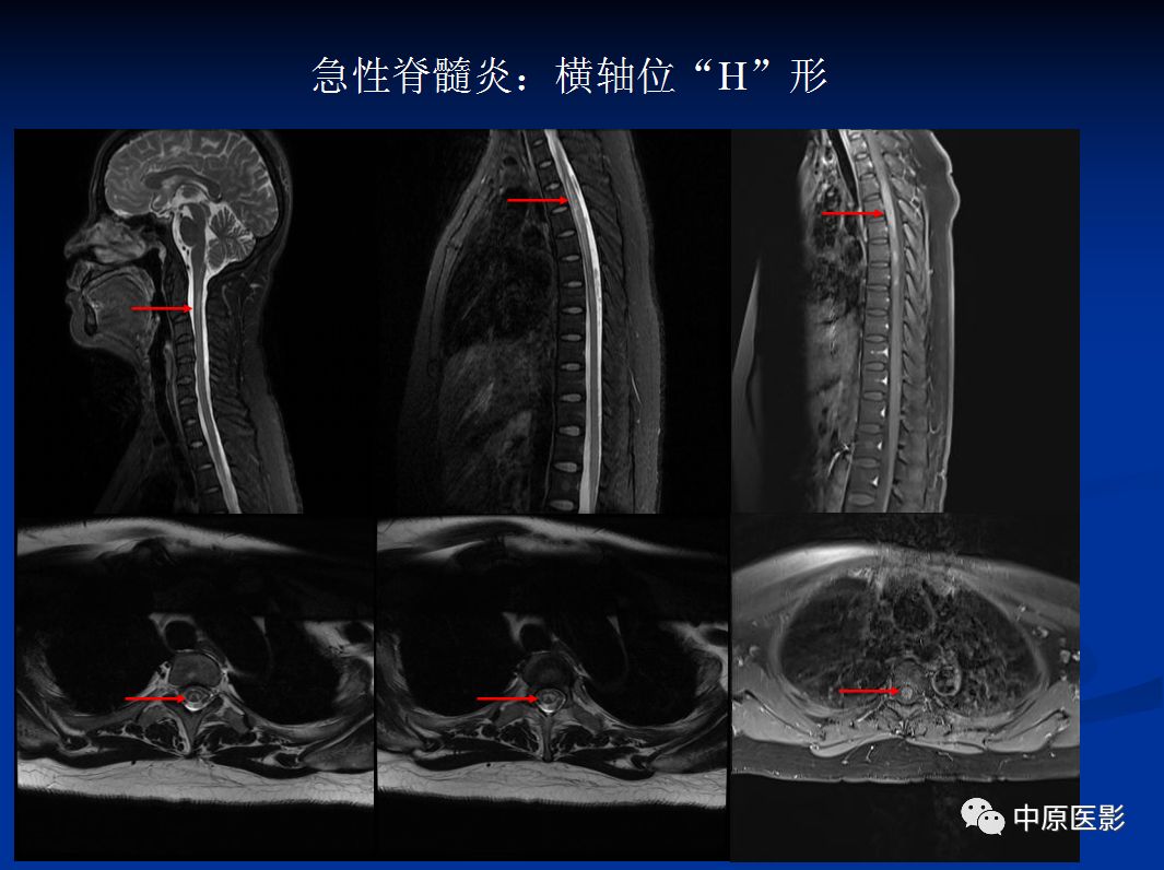 影像PPT - 【PPT】视神经脊髓炎谱系病的MRI诊断-36