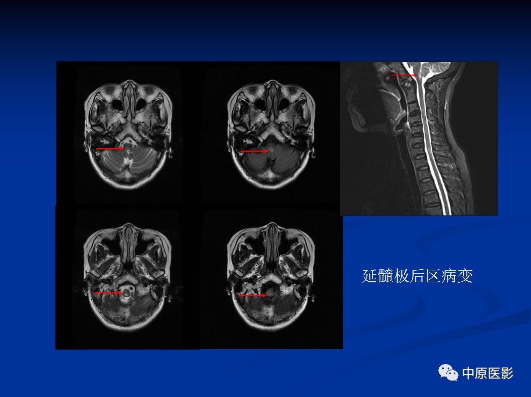 影像PPT - 【PPT】视神经脊髓炎谱系病的MRI诊断-41