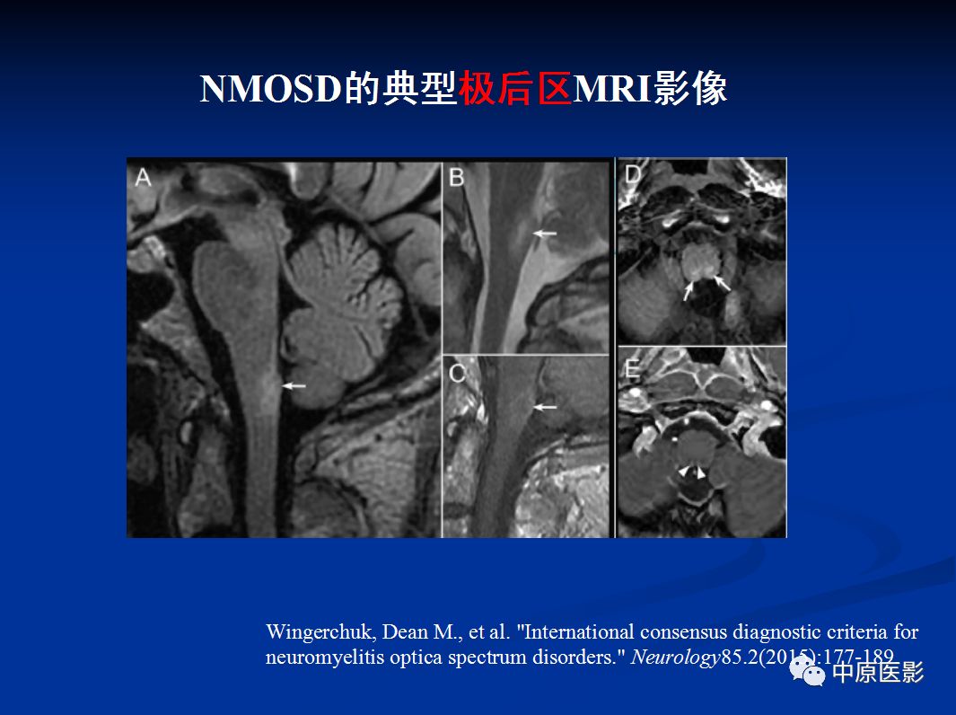 影像PPT - 【PPT】视神经脊髓炎谱系病的MRI诊断-40