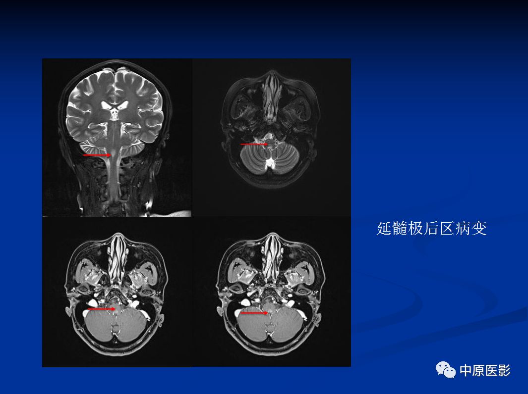 影像PPT - 【PPT】视神经脊髓炎谱系病的MRI诊断-42