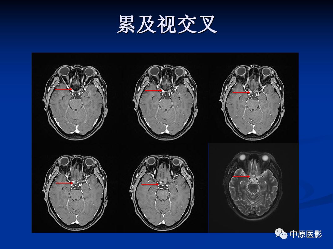 影像PPT - 【PPT】视神经脊髓炎谱系病的MRI诊断-24