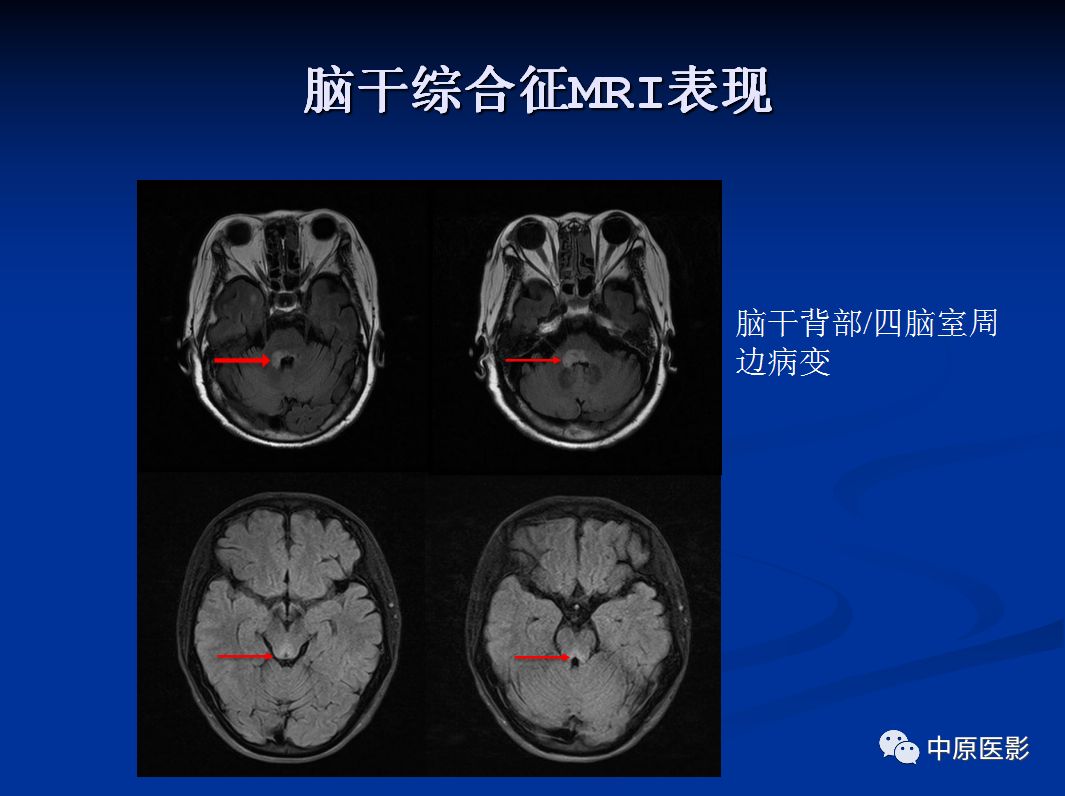 影像PPT - 【PPT】视神经脊髓炎谱系病的MRI诊断-45