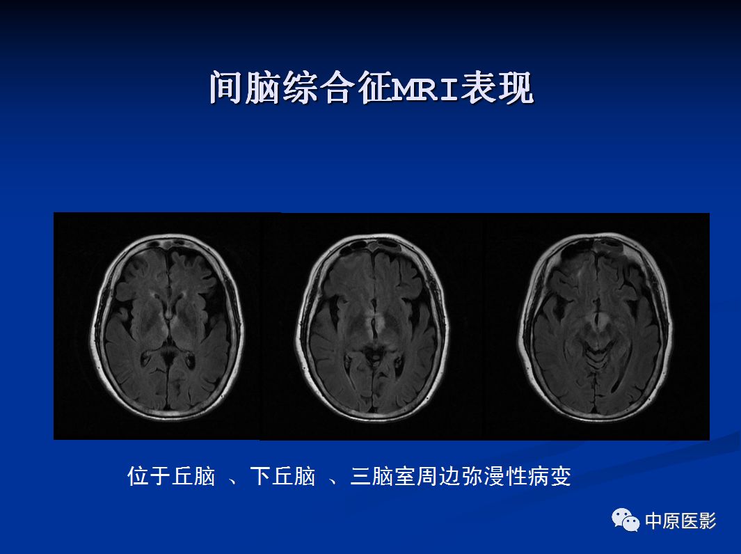 影像PPT - 【PPT】视神经脊髓炎谱系病的MRI诊断-46