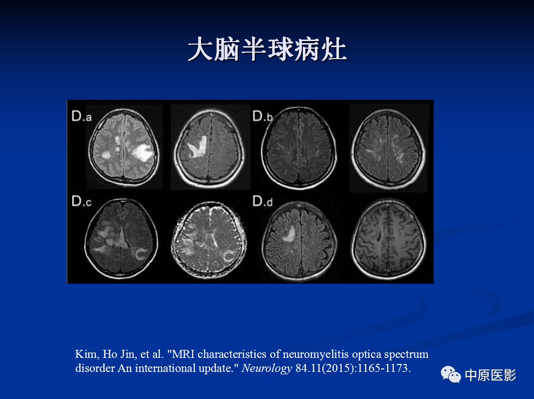 影像PPT - 【PPT】视神经脊髓炎谱系病的MRI诊断-49