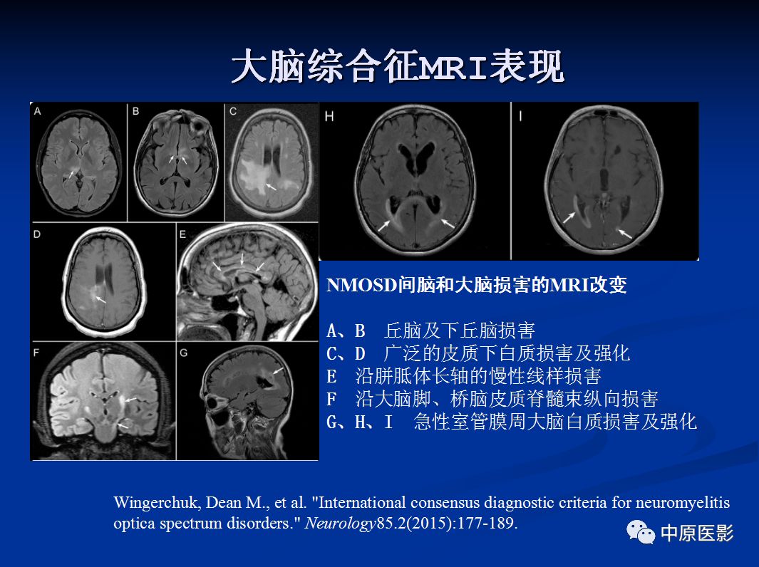 影像PPT - 【PPT】视神经脊髓炎谱系病的MRI诊断-48