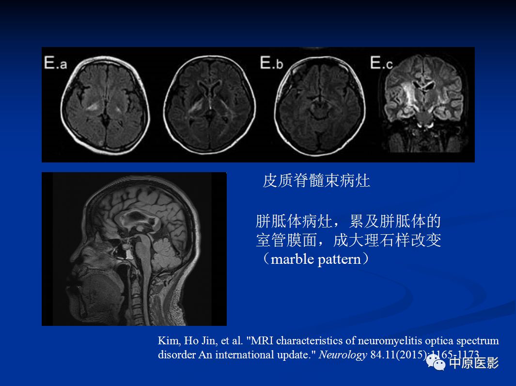 影像PPT - 【PPT】视神经脊髓炎谱系病的MRI诊断-50