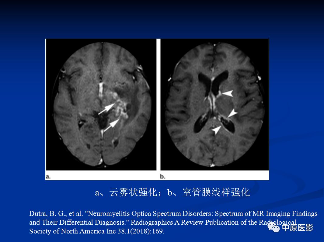 影像PPT - 【PPT】视神经脊髓炎谱系病的MRI诊断-52
