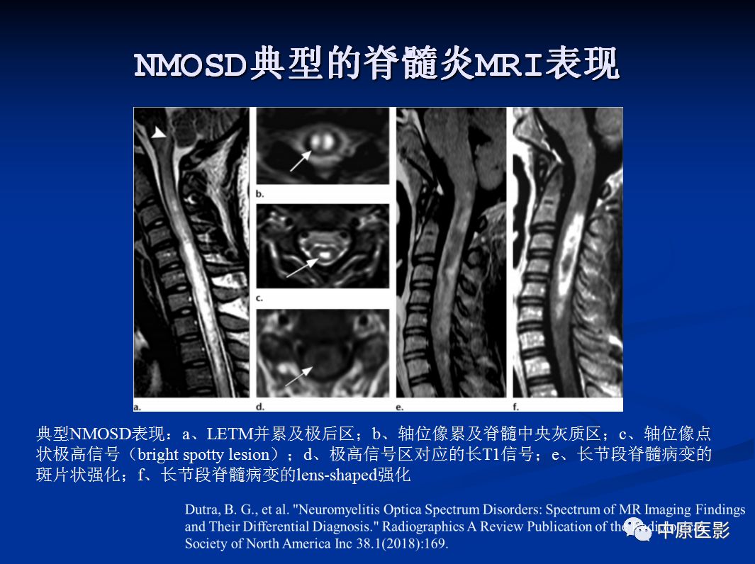 影像PPT - 【PPT】视神经脊髓炎谱系病的MRI诊断-33