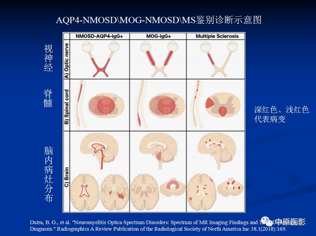 影像PPT - 【PPT】视神经脊髓炎谱系病的MRI诊断-59
