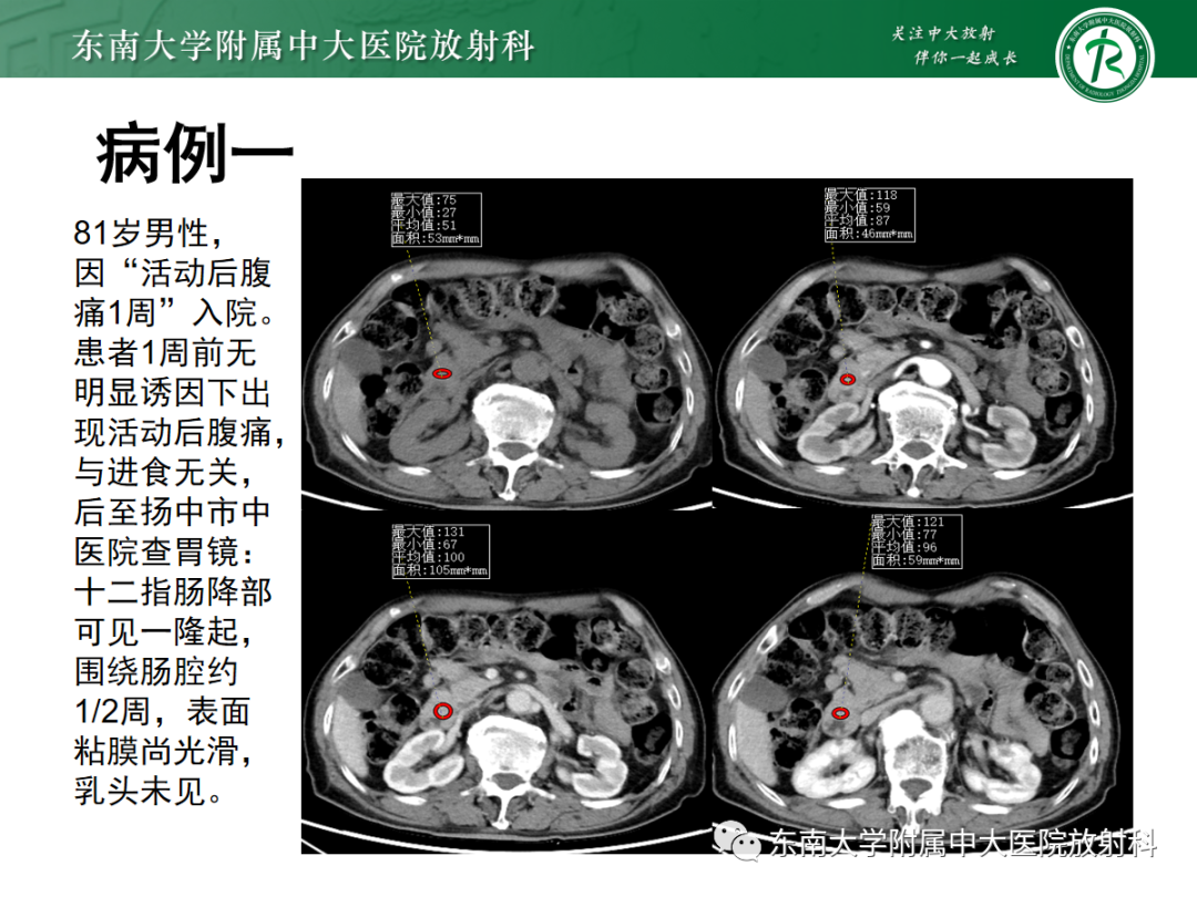 影像PPT - 【PPT】十二指肠占位—病例随访-1