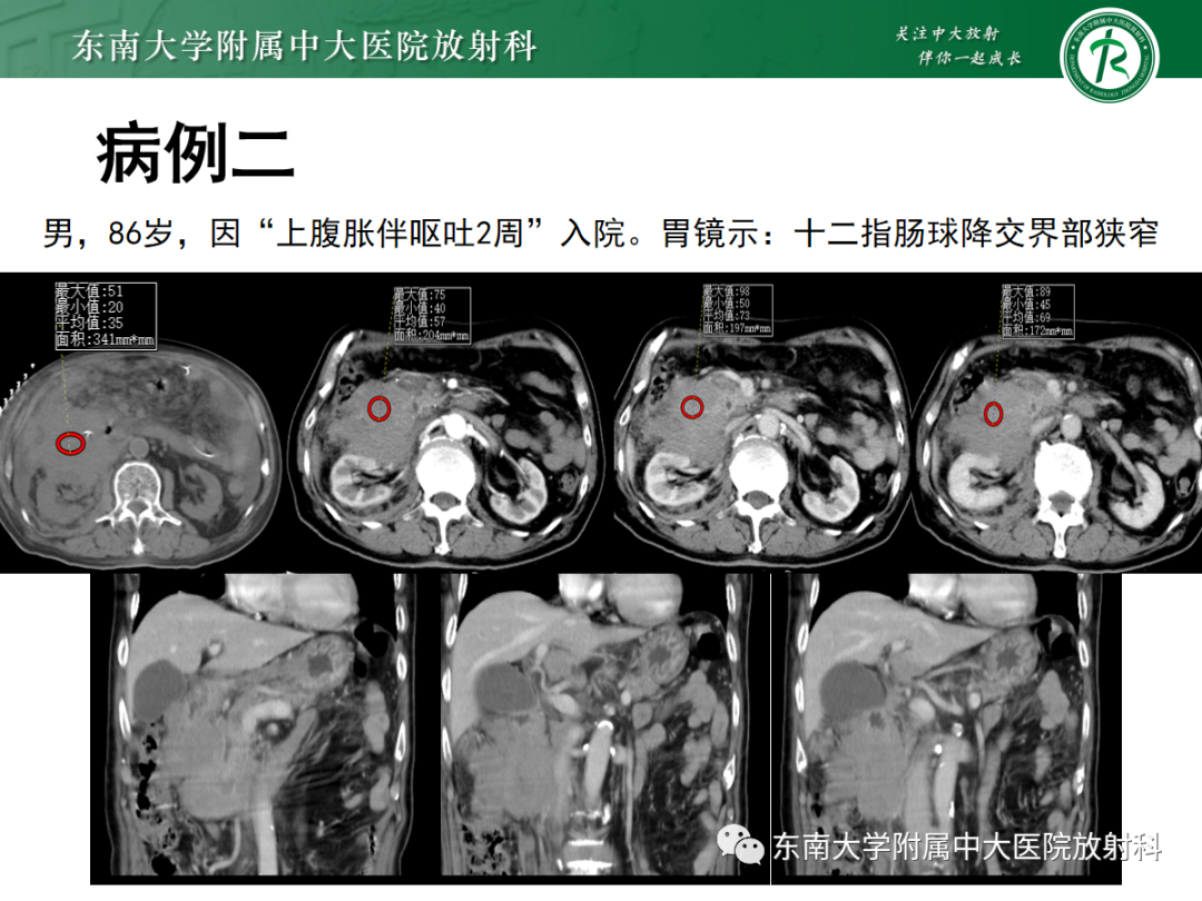 影像PPT - 【PPT】十二指肠占位—病例随访-4