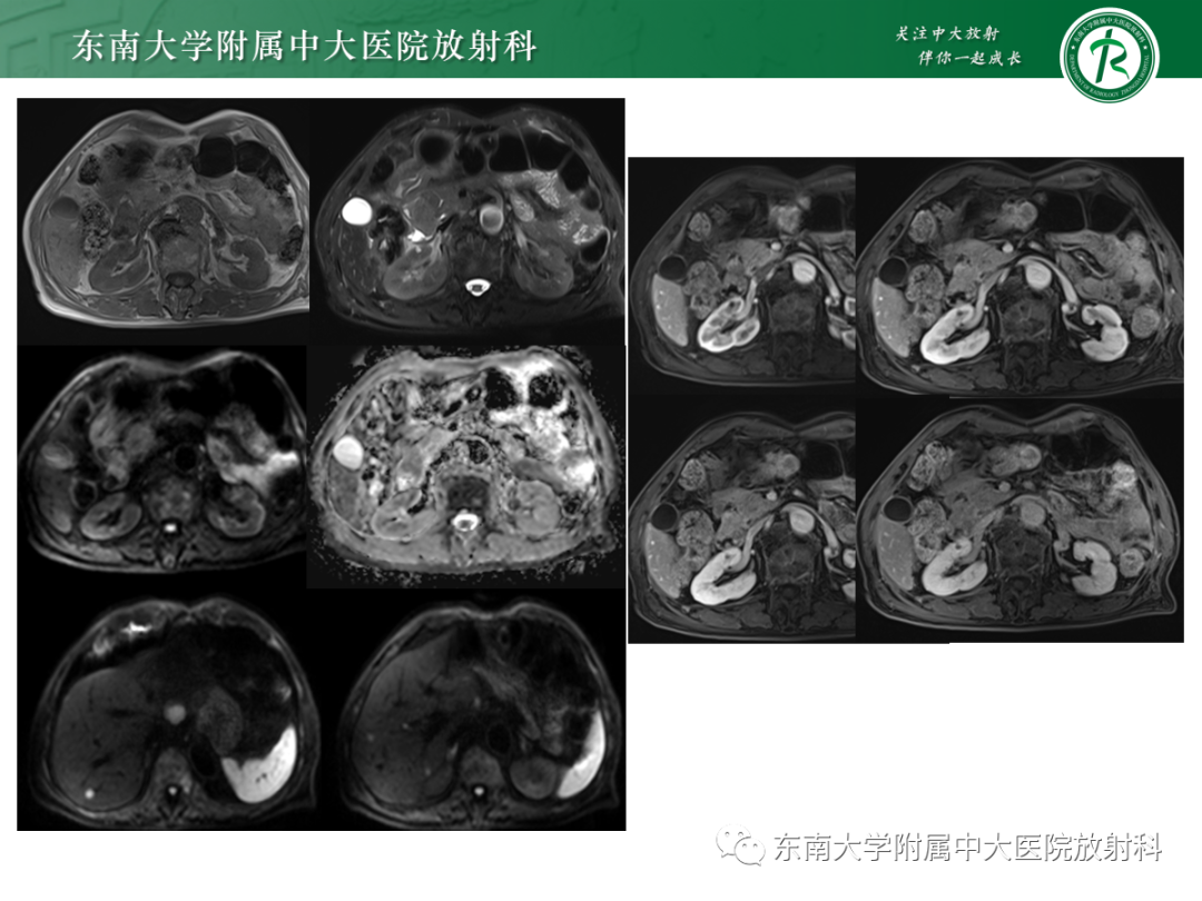 影像PPT - 【PPT】十二指肠占位—病例随访-2