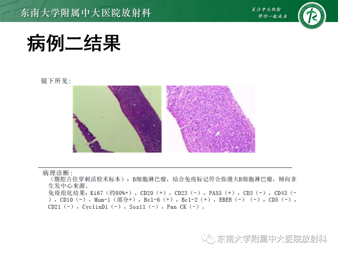 影像PPT - 【PPT】十二指肠占位—病例随访-6