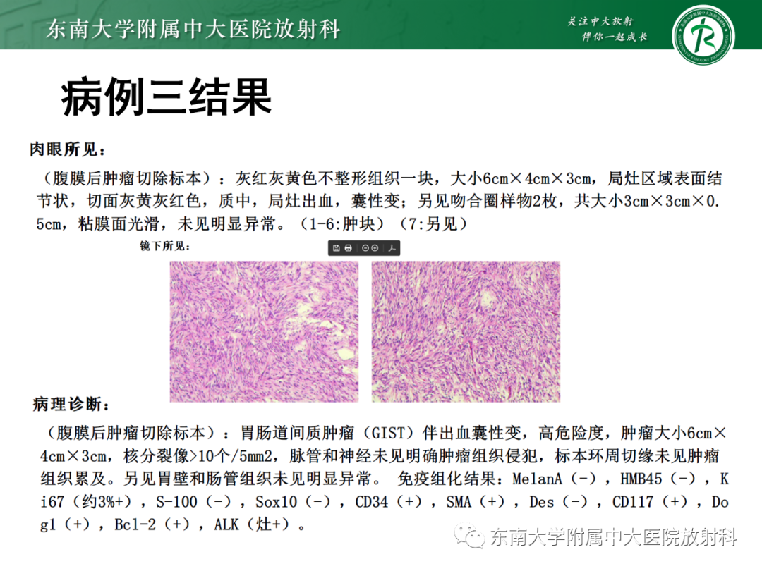 影像PPT - 【PPT】十二指肠占位—病例随访-8