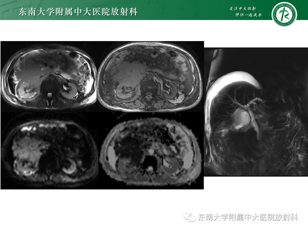 影像PPT - 【PPT】十二指肠占位—病例随访-5