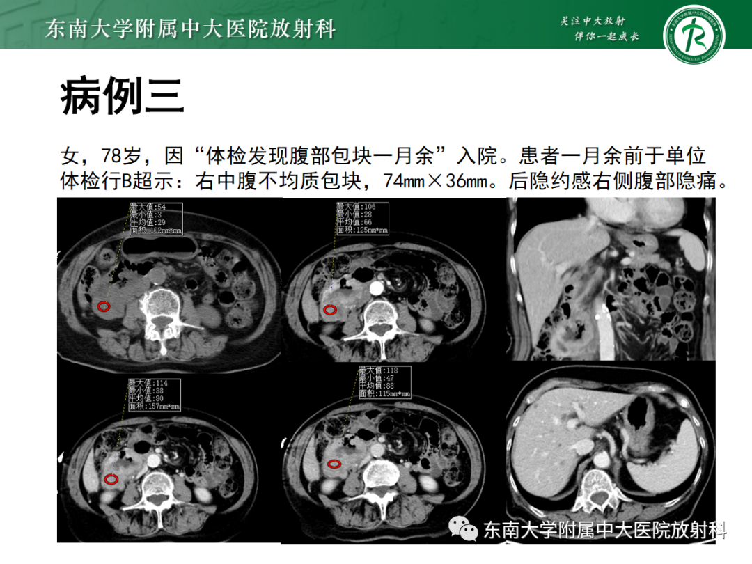 影像PPT - 【PPT】十二指肠占位—病例随访-7