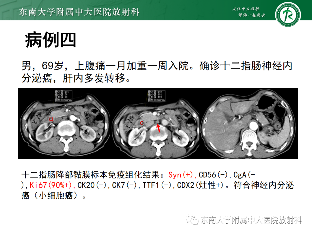 影像PPT - 【PPT】十二指肠占位—病例随访-18