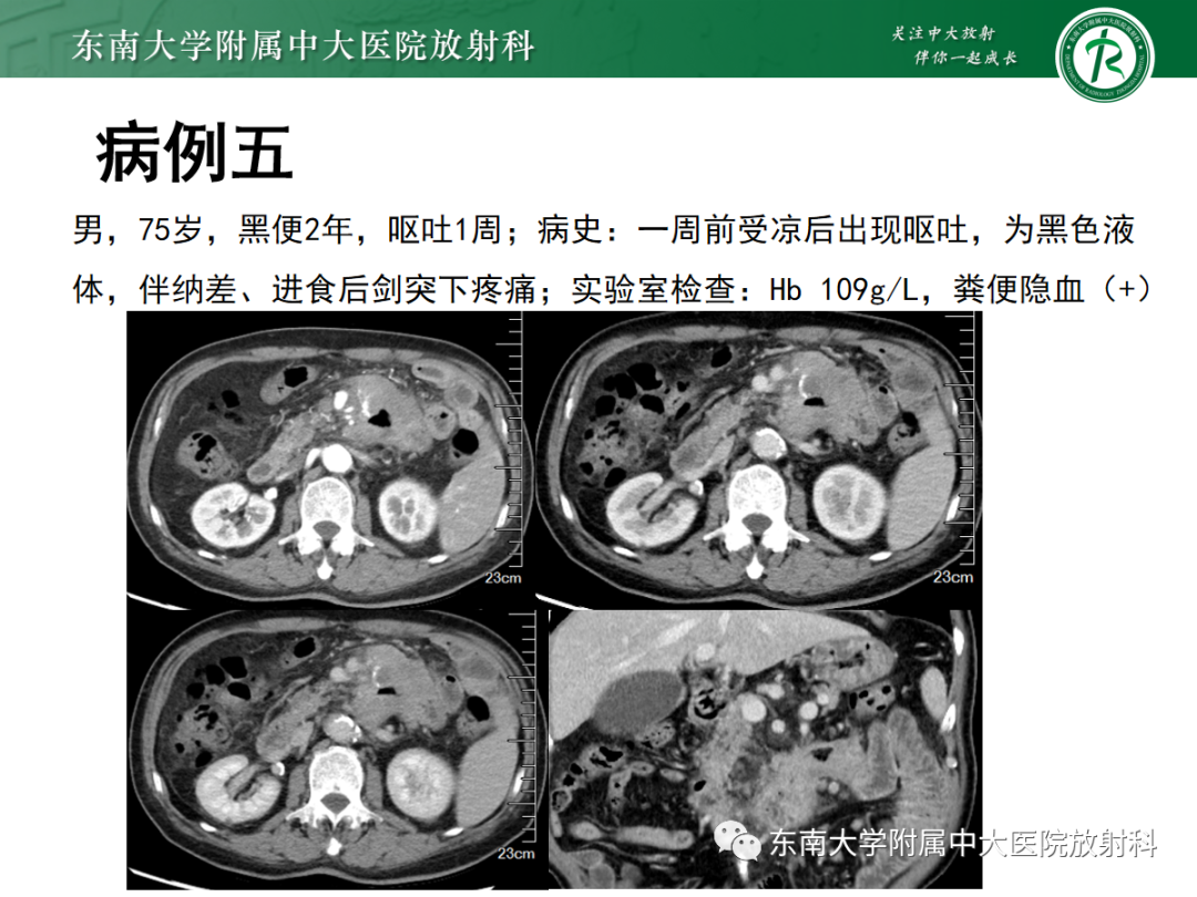 影像PPT - 【PPT】十二指肠占位—病例随访-20