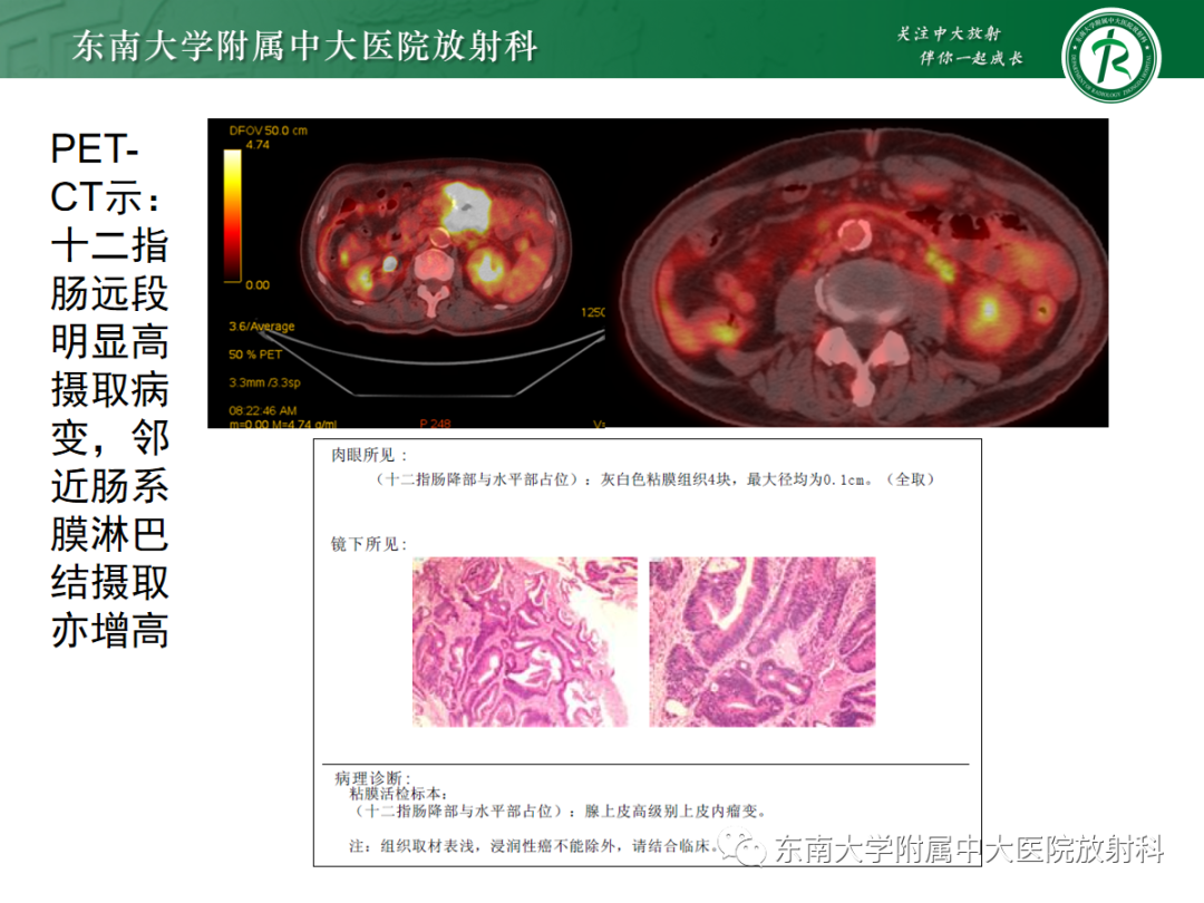 影像PPT - 【PPT】十二指肠占位—病例随访-21