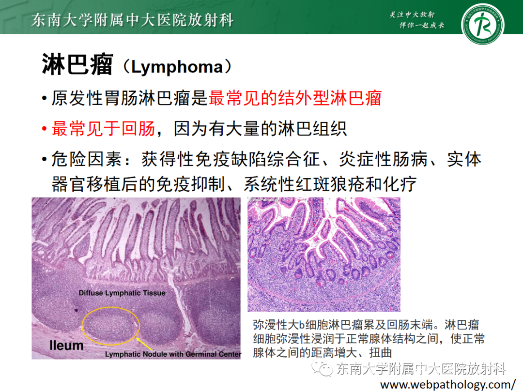 影像PPT - 【PPT】十二指肠占位—病例随访-22