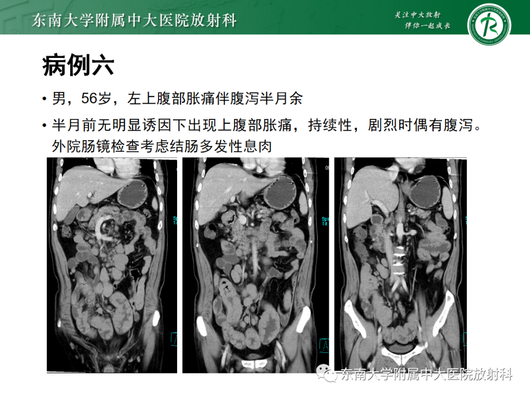 影像PPT - 【PPT】十二指肠占位—病例随访-24