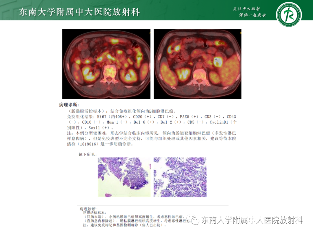 影像PPT - 【PPT】十二指肠占位—病例随访-25