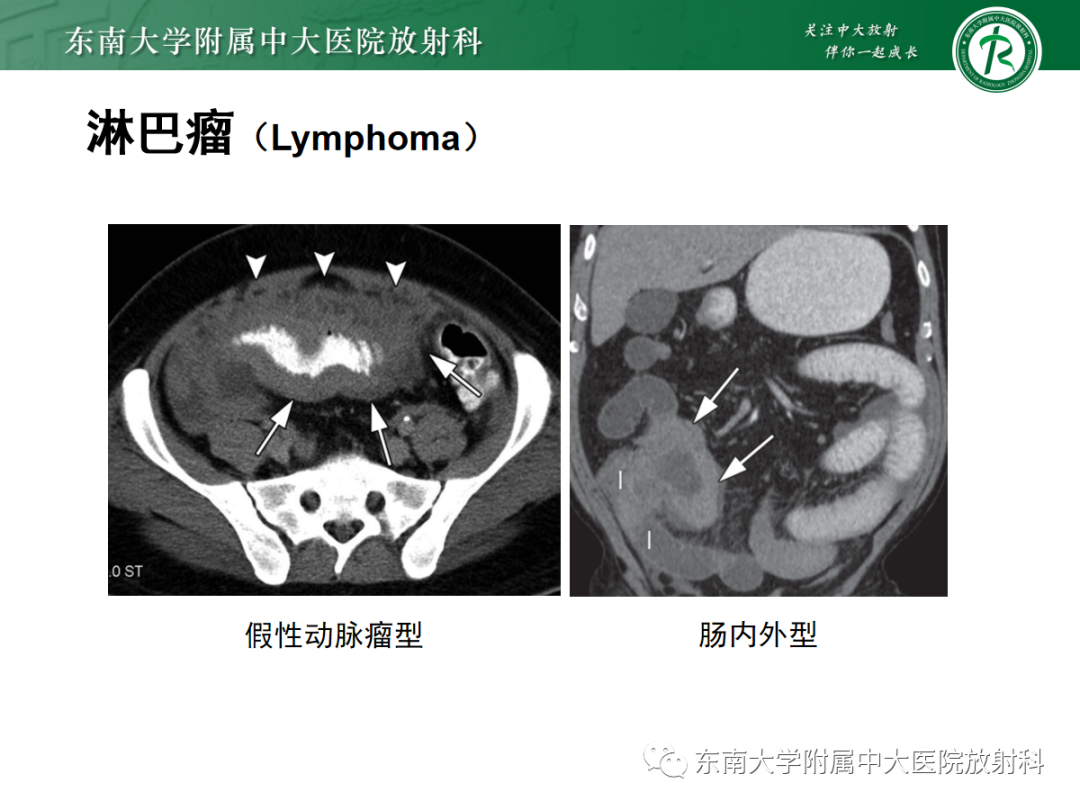 影像PPT - 【PPT】十二指肠占位—病例随访-26