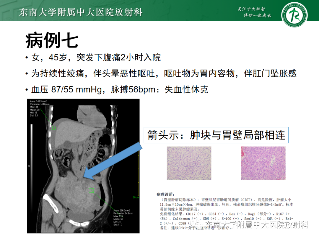 影像PPT - 【PPT】十二指肠占位—病例随访-31