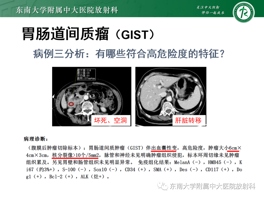 影像PPT - 【PPT】十二指肠占位—病例随访-32