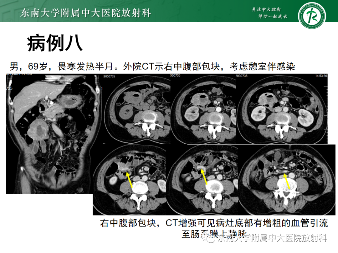 影像PPT - 【PPT】十二指肠占位—病例随访-34
