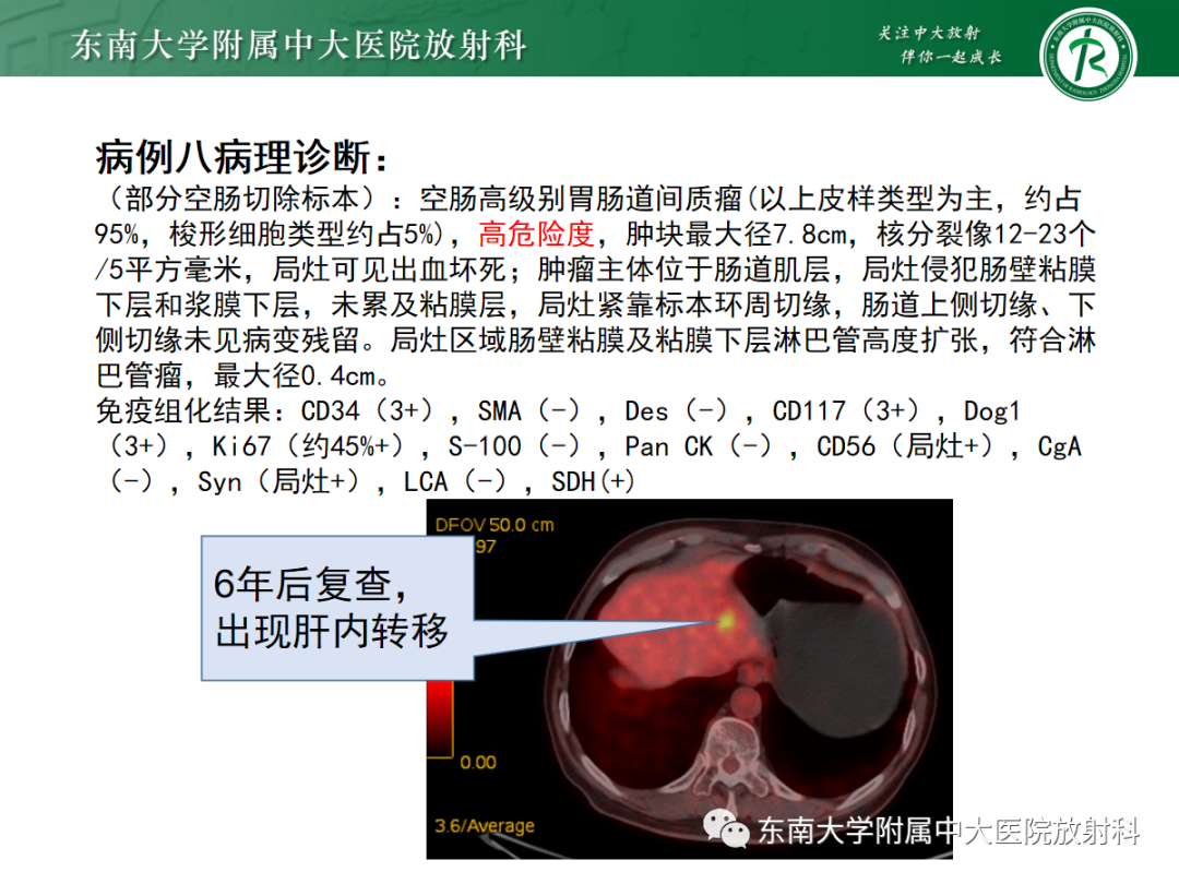 影像PPT - 【PPT】十二指肠占位—病例随访-36