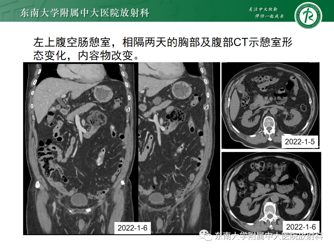 影像PPT - 【PPT】十二指肠占位—病例随访-37
