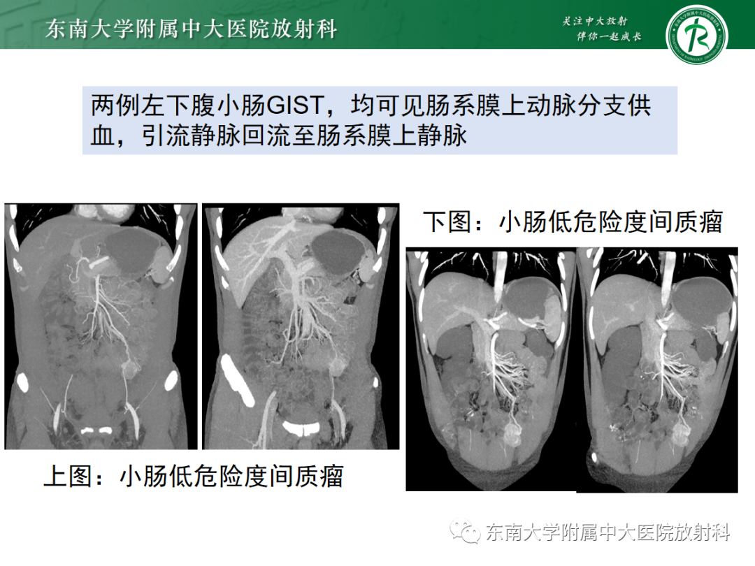 影像PPT - 【PPT】十二指肠占位—病例随访-30