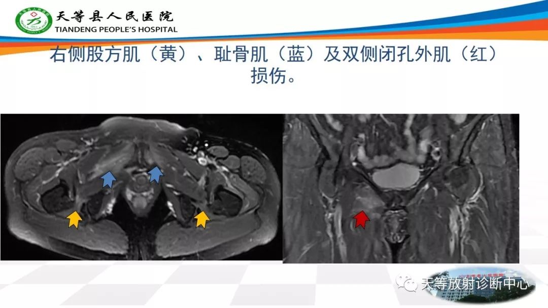 影像PPT - 【PPT】大转子疼痛综合征-8 影像PPT - 【PPT】大转子疼痛综合征-8