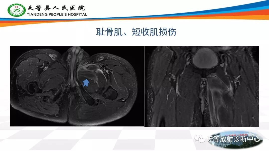 影像PPT - 【PPT】大转子疼痛综合征-3 影像PPT - 【PPT】大转子疼痛综合征-3