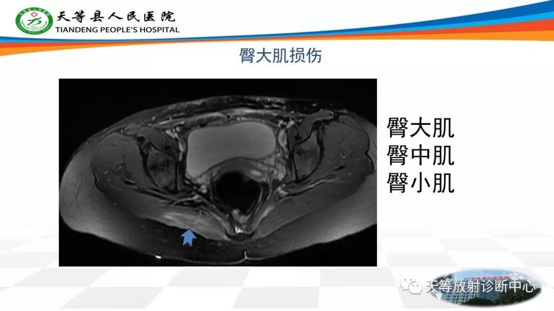 影像PPT - 【PPT】大转子疼痛综合征-9 影像PPT - 【PPT】大转子疼痛综合征-9