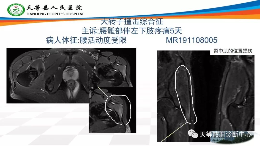 影像PPT - 【PPT】大转子疼痛综合征-13 影像PPT - 【PPT】大转子疼痛综合征-13
