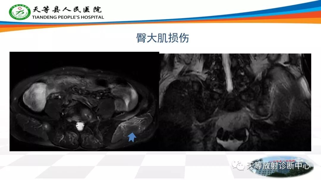 影像PPT - 【PPT】大转子疼痛综合征-11 影像PPT - 【PPT】大转子疼痛综合征-11