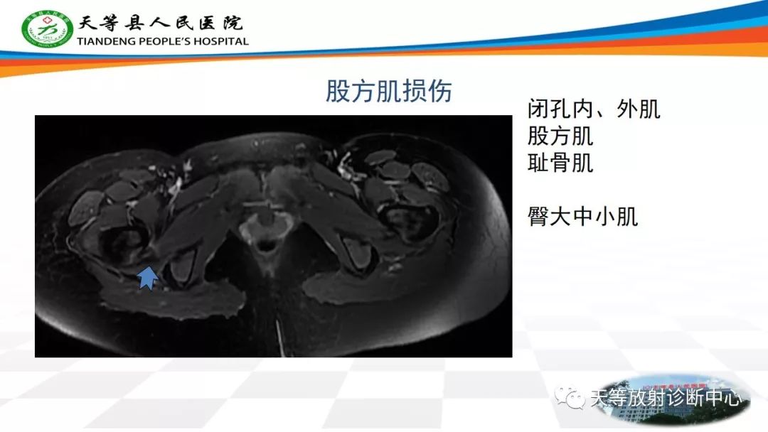 影像PPT - 【PPT】大转子疼痛综合征-7 影像PPT - 【PPT】大转子疼痛综合征-7