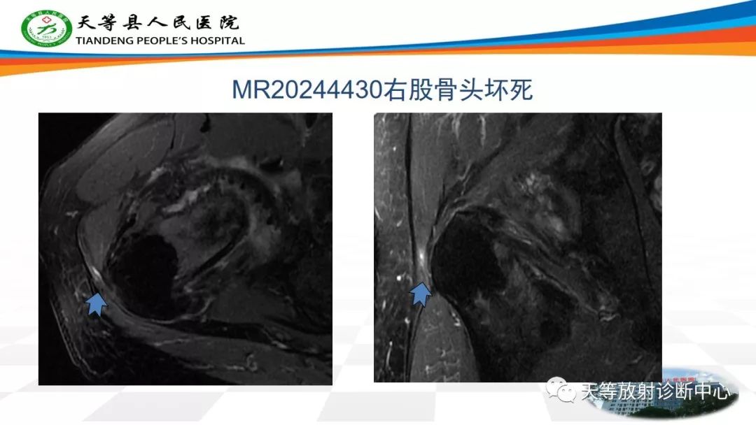 影像PPT - 【PPT】大转子疼痛综合征-5 影像PPT - 【PPT】大转子疼痛综合征-5