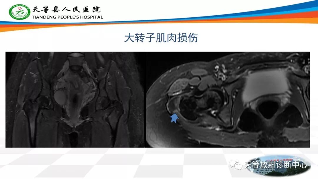 影像PPT - 【PPT】大转子疼痛综合征-10 影像PPT - 【PPT】大转子疼痛综合征-10