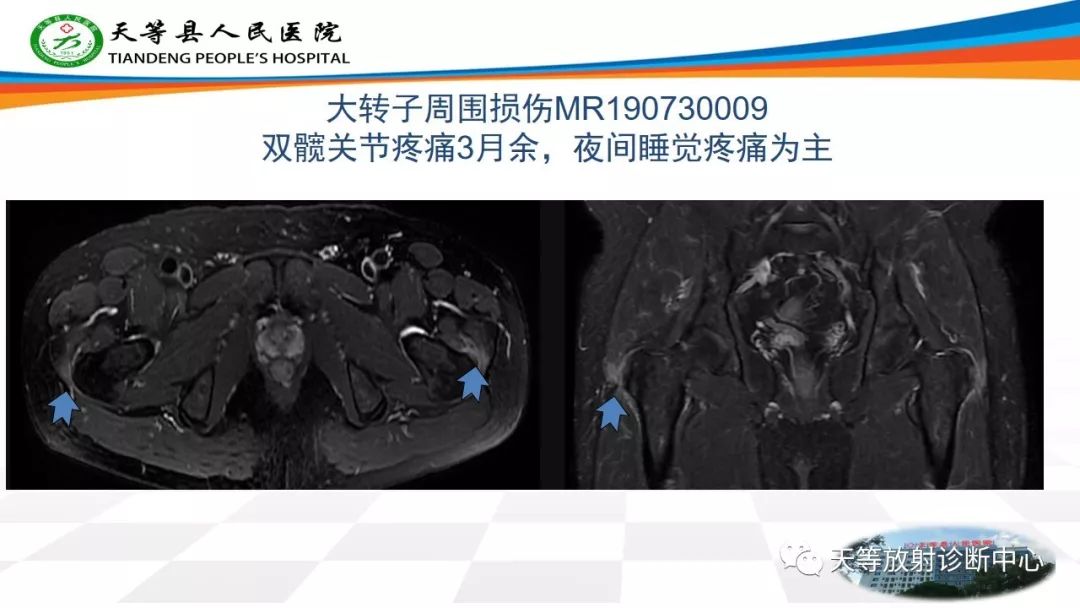 影像PPT - 【PPT】大转子疼痛综合征-12 影像PPT - 【PPT】大转子疼痛综合征-12